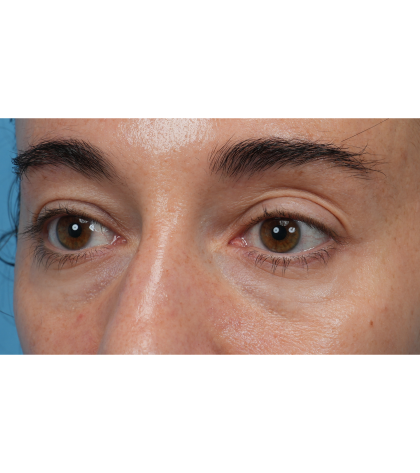 CO2 Laser Resurfacing Before & After Patient #3533