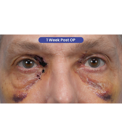 Lesion Removal Before & After Patient #3484