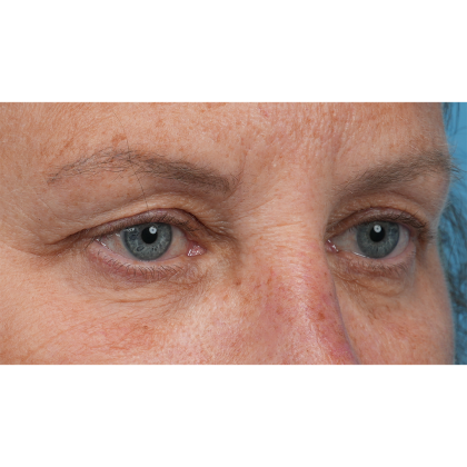 Upper Blepharoplasty Before & After Patient #3575