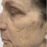 Ultra Clear Before & After Patient #3550