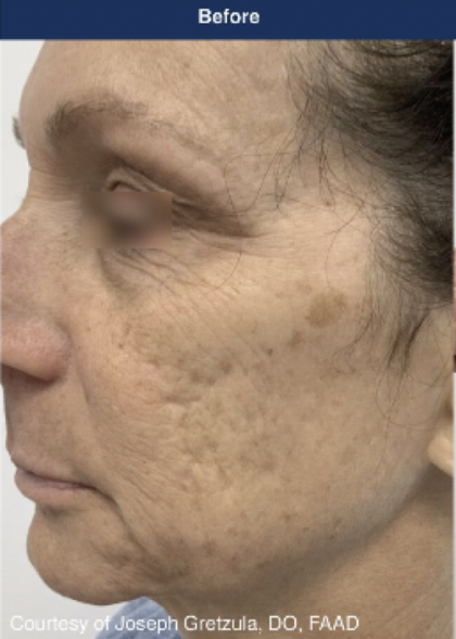 Ultra Clear Before & After Patient #3550