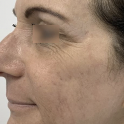 Ultra Clear Before & After Patient #3550