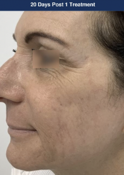 Ultra Clear Before & After Patient #3550