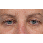Upper Blepharoplasty Before & After Patient #3575