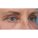 Upper Blepharoplasty Before & After Patient #3575