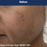 Ultra Clear Before & After Patient #3551