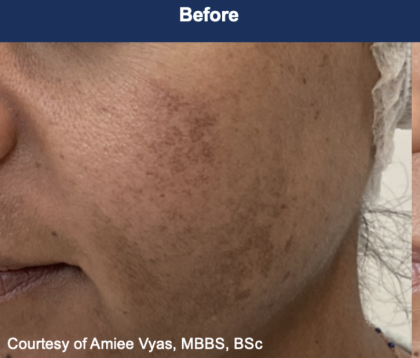 Ultra Clear Before & After Patient #3551