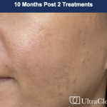 Ultra Clear Before & After Patient #3551