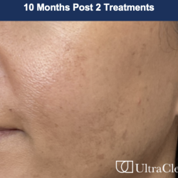Ultra Clear Before & After Patient #3551
