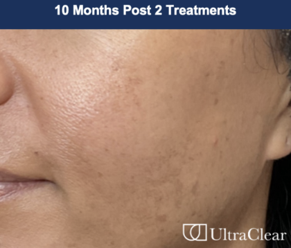Ultra Clear Before & After Patient #3551