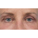 Upper Blepharoplasty Before & After Patient #3575