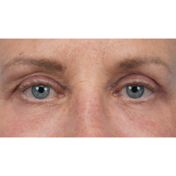 Upper Blepharoplasty Before & After Patient #3575