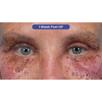 Upper Blepharoplasty Before & After Patient #3575
