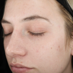 Ultra Clear Before & After Patient #3552