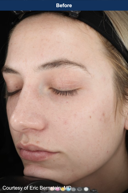 Ultra Clear Before & After Patient #3552