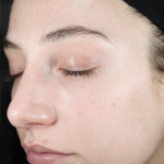 Ultra Clear Before & After Patient #3552