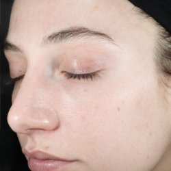 Ultra Clear Before & After Patient #3552