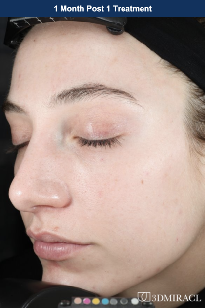 Ultra Clear Before & After Patient #3552