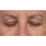 Upper Blepharoplasty Before & After Patient #3575