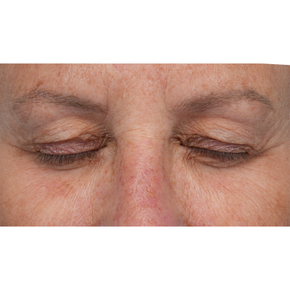 Upper Blepharoplasty Before & After Patient #3575