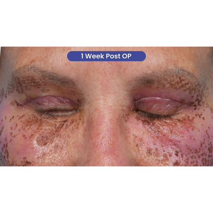 Upper Blepharoplasty Before & After Patient #3575