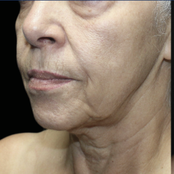 Ultra Clear Before & After Patient #3553