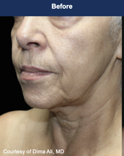 Ultra Clear Before & After Patient #3553