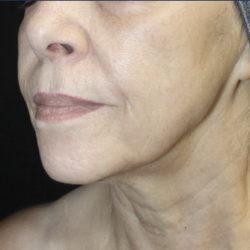 Ultra Clear Before & After Patient #3553
