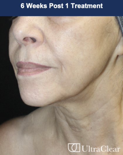 Ultra Clear Before & After Patient #3553
