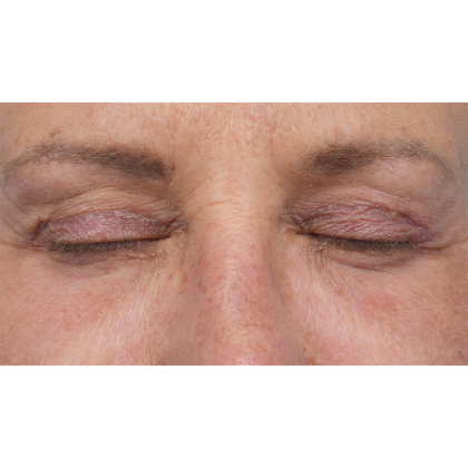Upper Blepharoplasty Before & After Patient #3575