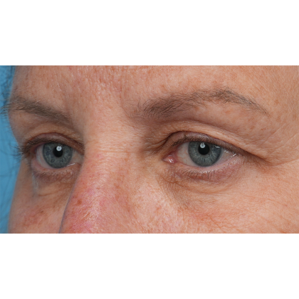 Upper Blepharoplasty Before & After Patient #3575