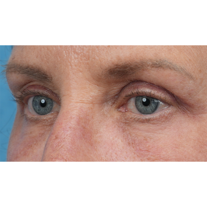 Upper Blepharoplasty Before & After Patient #3575