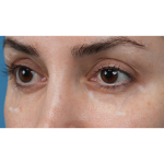 Vein Removal Before & After Patient #3580