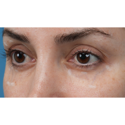 Vein Removal Before & After Patient #3580