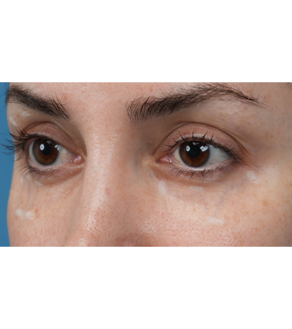 Vein Removal Before & After Patient #3580