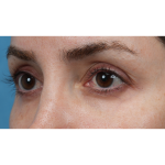 Vein Removal Before & After Patient #3580