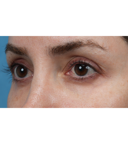 Vein Removal Before & After Patient #3580