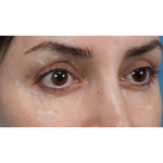 Vein Removal Before & After Patient #3580