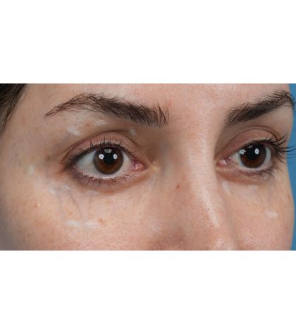 Vein Removal Before & After Patient #3580