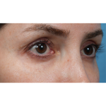 Vein Removal Before & After Patient #3580