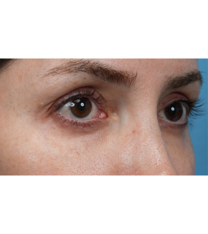 Vein Removal Before & After Patient #3580