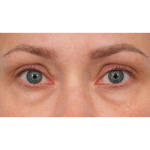 CO2 Laser Resurfacing Before & After Patient #3591