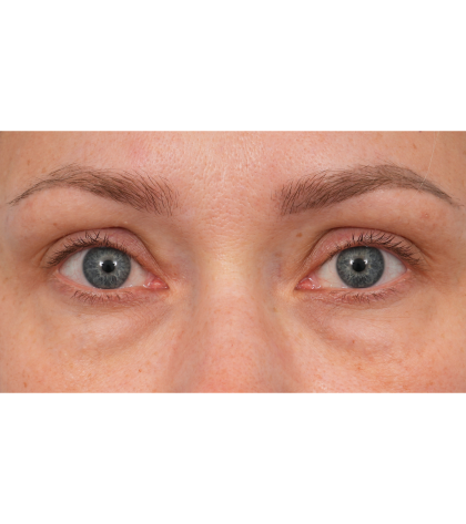 CO2 Laser Resurfacing Before & After Patient #3591