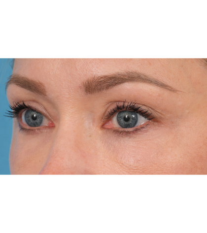 CO2 Laser Resurfacing Before & After Patient #3591