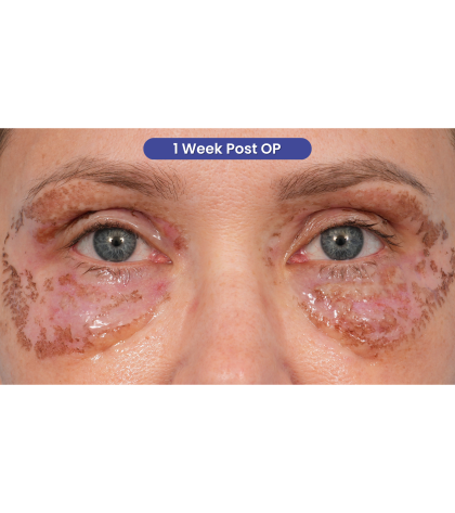 CO2 Laser Resurfacing Before & After Patient #3591