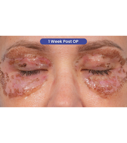 CO2 Laser Resurfacing Before & After Patient #3591