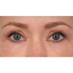 CO2 Laser Resurfacing Before & After Patient #3591