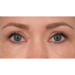 CO2 Laser Resurfacing Before & After Patient #3591