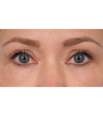 CO2 Laser Resurfacing Before & After Patient #3591