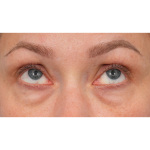 CO2 Laser Resurfacing Before & After Patient #3591